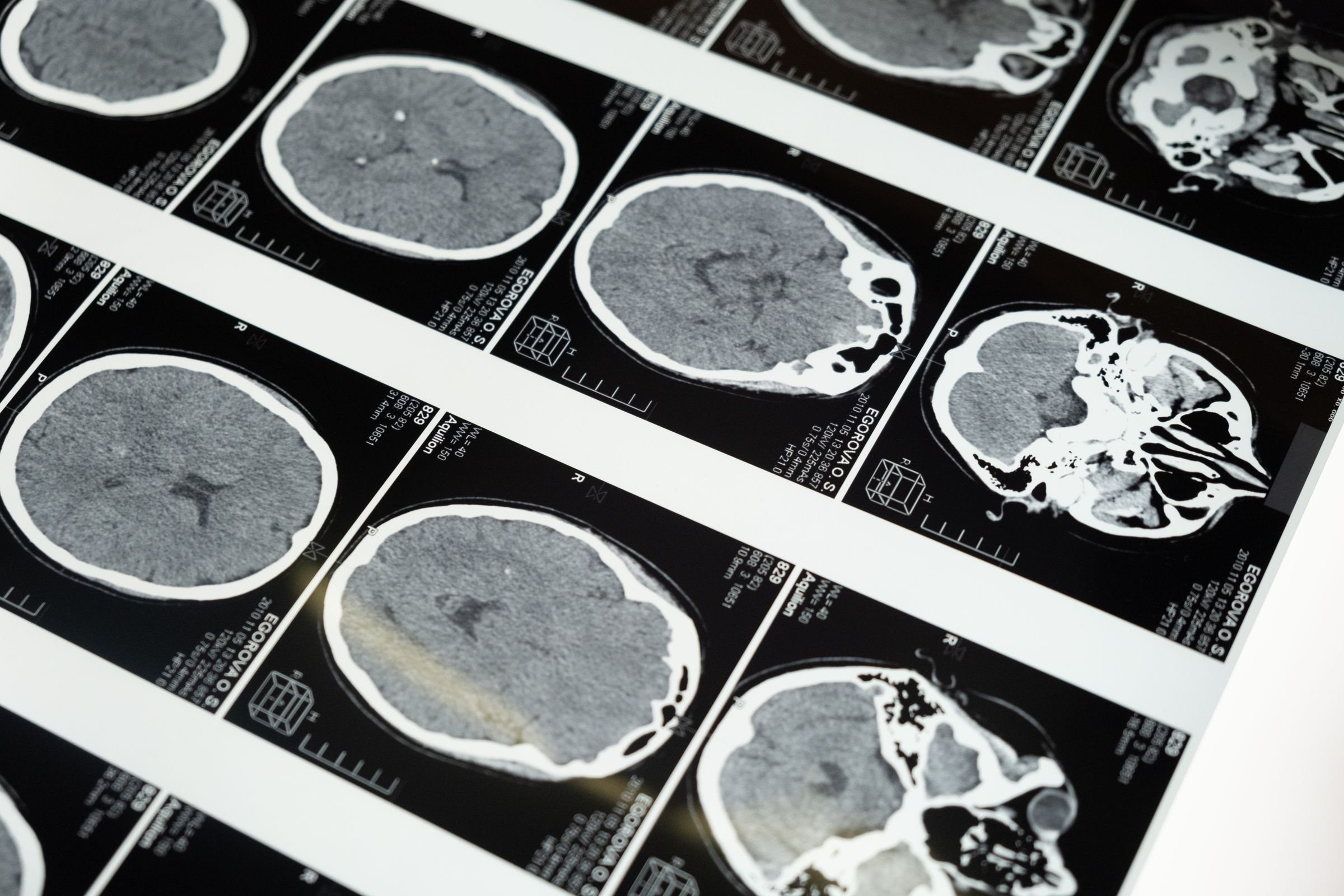 Brain scans laid out on a lightbox